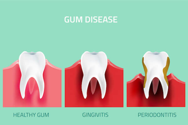 What is the Difference Between Gingivitis and Periodontitis?