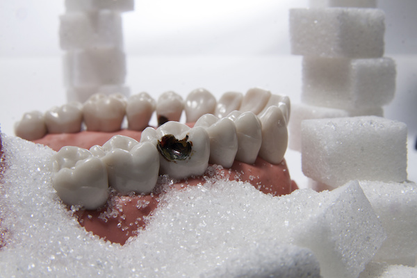 Sugar and Periodontal Disease