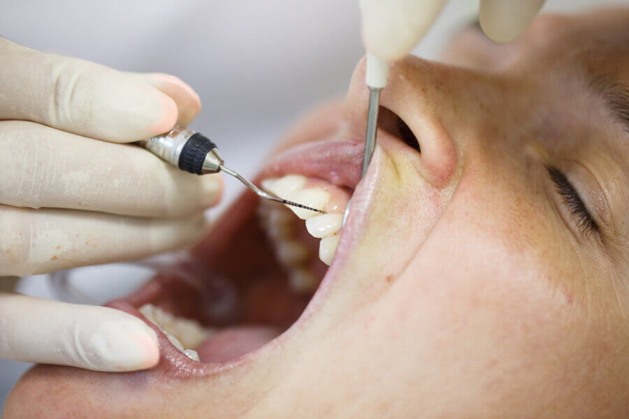 Periodontal probe, held by dental hygienist, measuring pocket depths around tooth, examining progression of periodontal disease. Dental hygiene, periodontal disease and prevention concept.