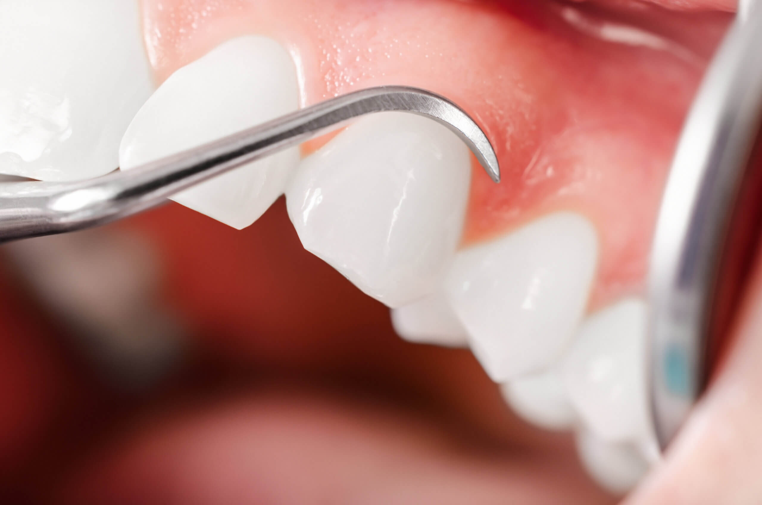 Below The Gum Line Vero Implants & Periodontics