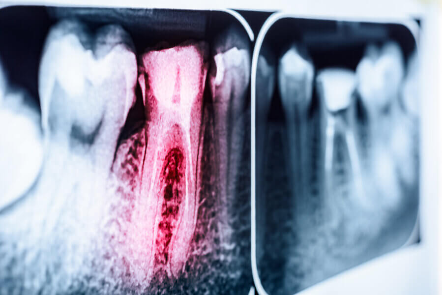 Tooth decay and periodontal disease.