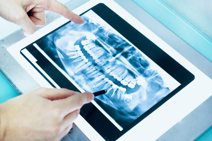 Dental x-ray and dentist hands
periodontal disease. periodontitis