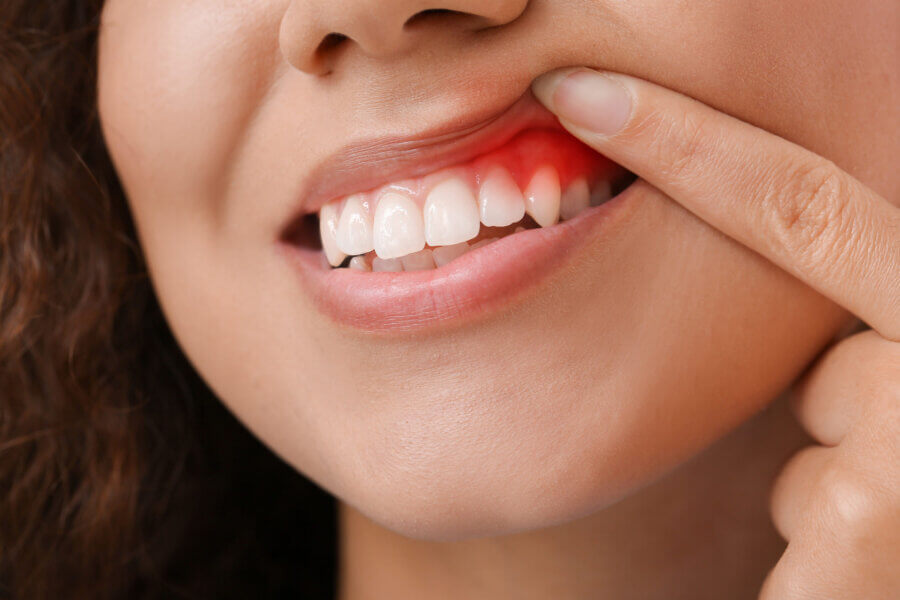 periodontal diseases Woman with gum inflammation, closeup