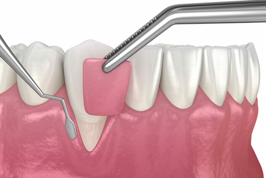 Gum Recession: Soft tissue graft surgery. 3D illustration of Dental  treatment