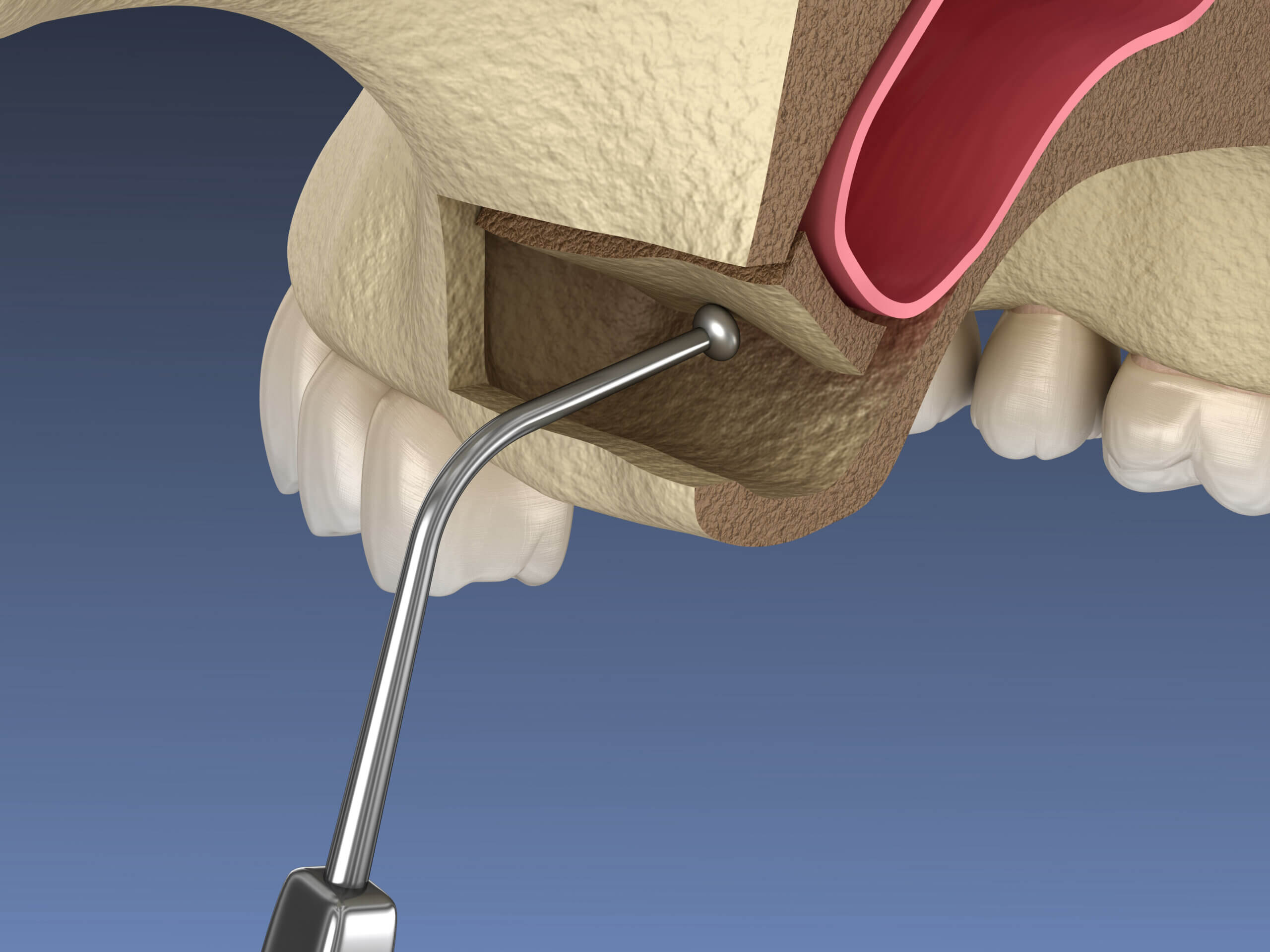 What Is Sinus Augmentation? Vero Implants & Periodontics